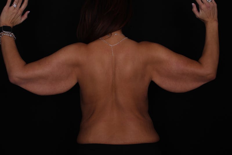 Arm Lift Before & After Gallery - Patient 371253 - Image 3