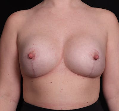 Breast Augmentation with Lift Before & After Gallery - Patient 974364 - Image 2