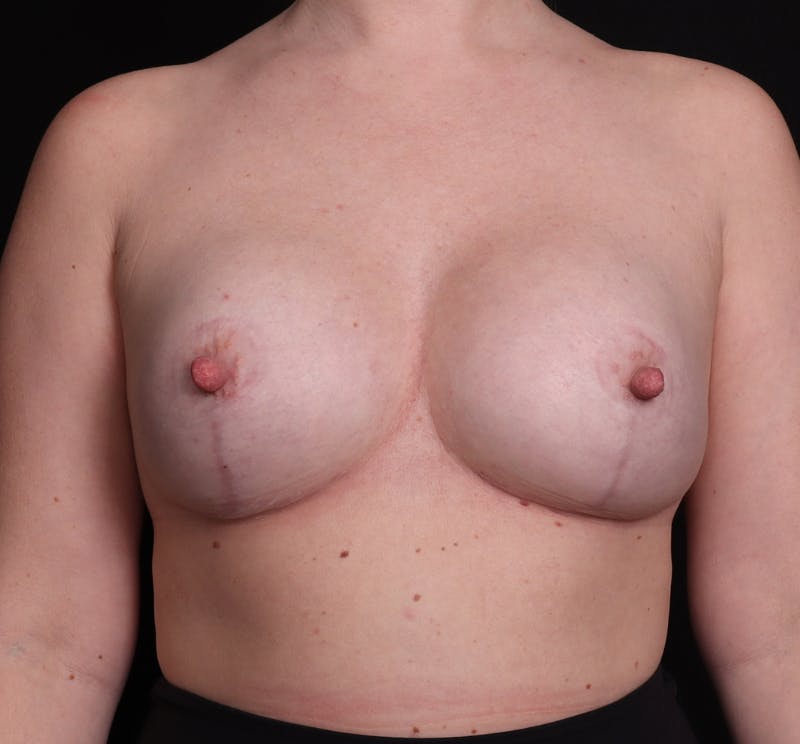 Breast Augmentation with Lift Before & After Gallery - Patient 974364 - Image 2