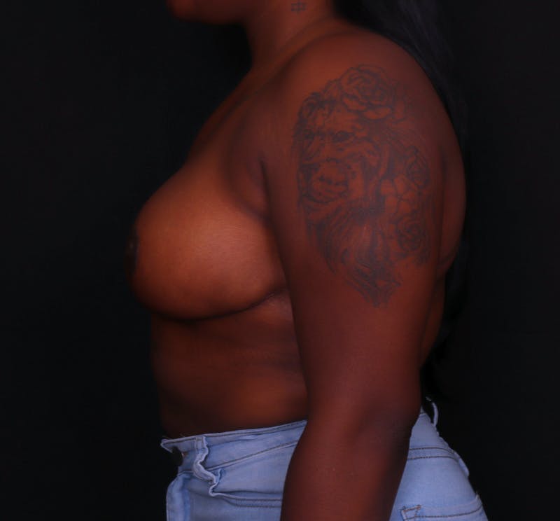 Breast Reduction Before & After Gallery - Patient 797347 - Image 4