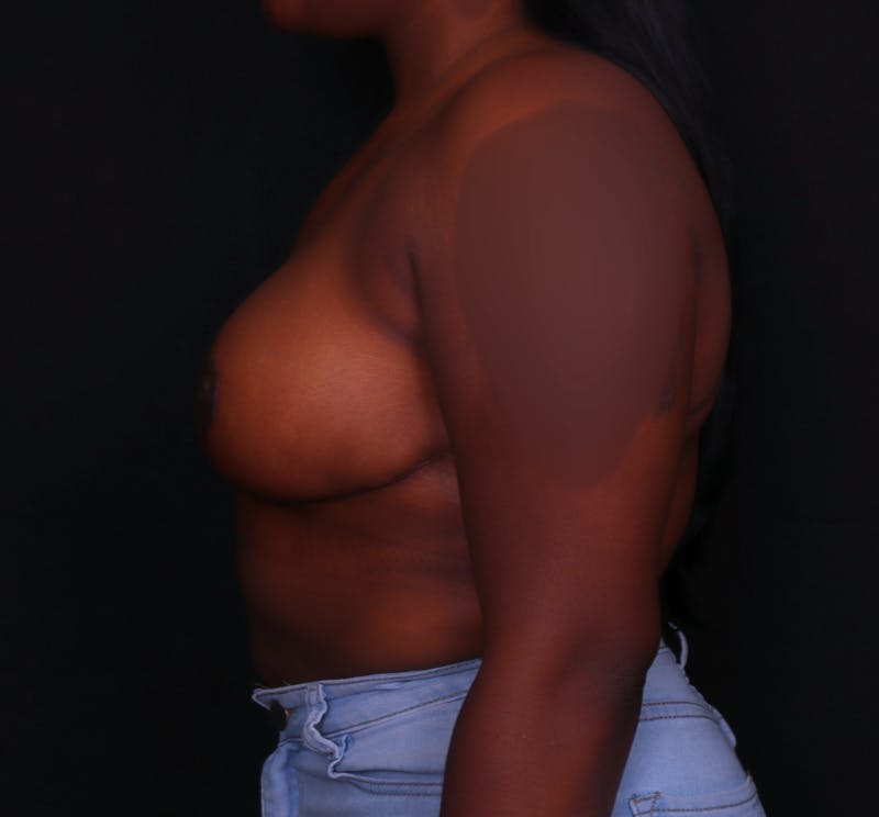 Breast Reduction Before & After Gallery - Patient 797347 - Image 4