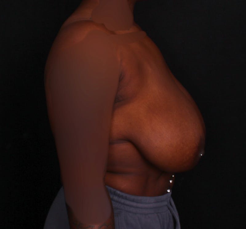 Breast Reduction Before & After Gallery - Patient 797347 - Image 5