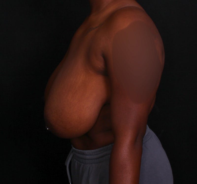 Breast Reduction Before & After Gallery - Patient 797347 - Image 3