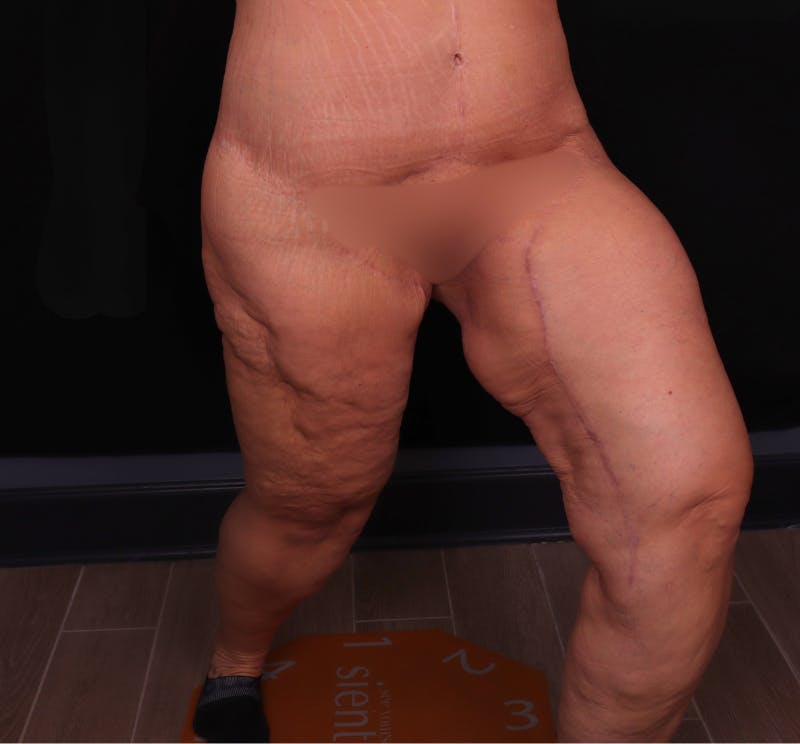 Thigh Lift Before & After Gallery - Patient 228152 - Image 6