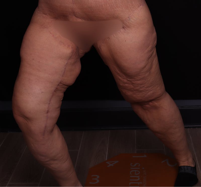 Thigh Lift Before & After Gallery - Patient 228152 - Image 4
