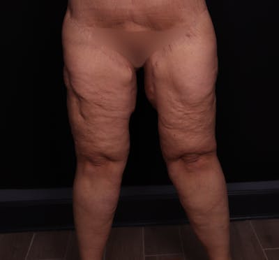 Thigh Lift Before & After Gallery - Patient 228152 - Image 2
