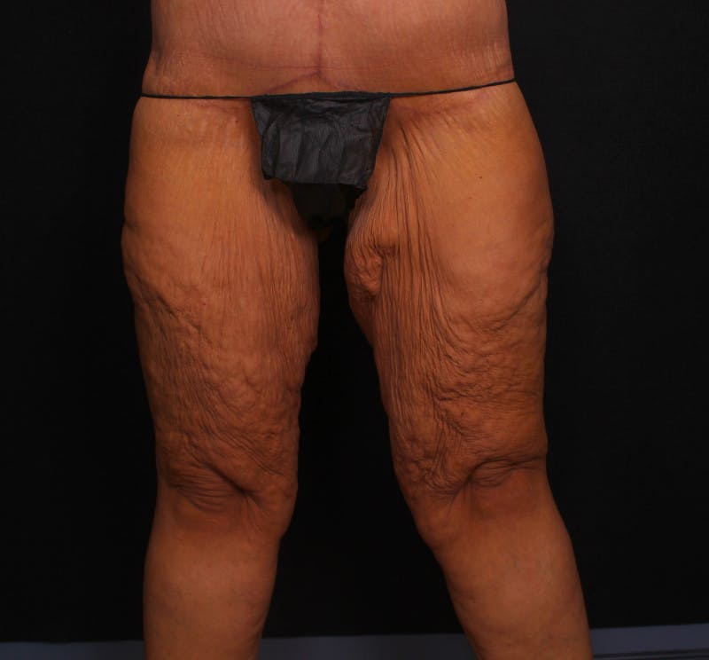 Thigh Lift Before & After Gallery - Patient 228152 - Image 1
