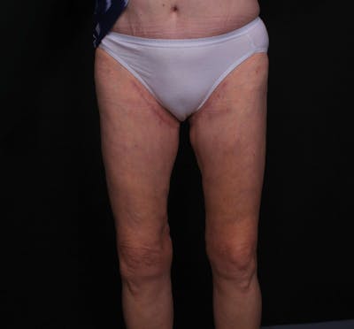 Thigh Lift Before & After Gallery - Patient 339799 - Image 2