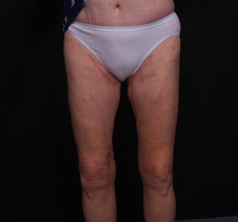 Thigh Lift Before & After Gallery - Patient 339799 - Image 2
