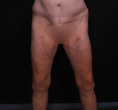Thigh Lift Before & After Gallery - Patient 339799 - Image 1
