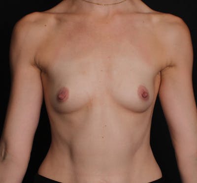 Breast Augmentation Before & After Gallery - Patient 323774 - Image 1