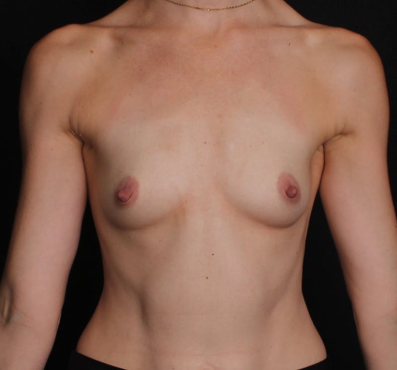 Breast Augmentation Before & After Gallery - Patient 323774 - Image 1