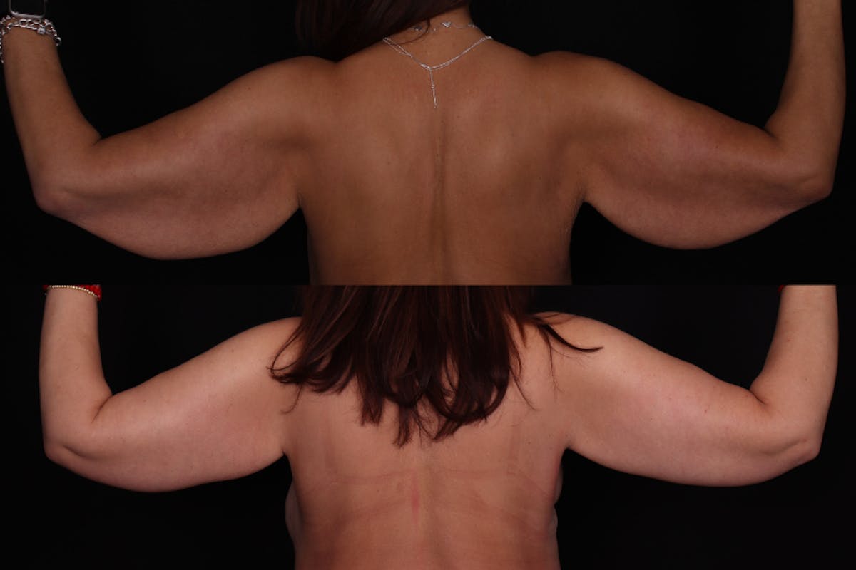 Arm Lift Before & After Gallery - Patient 371253 - Image 2