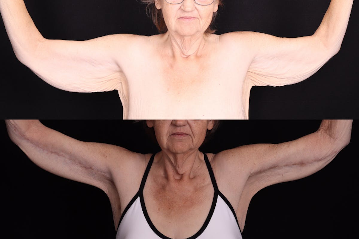 Arm Lift Before & After Gallery - Patient 823105 - Image 1