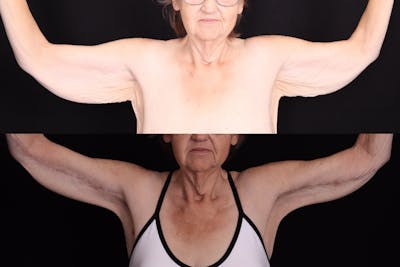 Arm Lift Before & After Gallery - Patient 823105 - Image 1