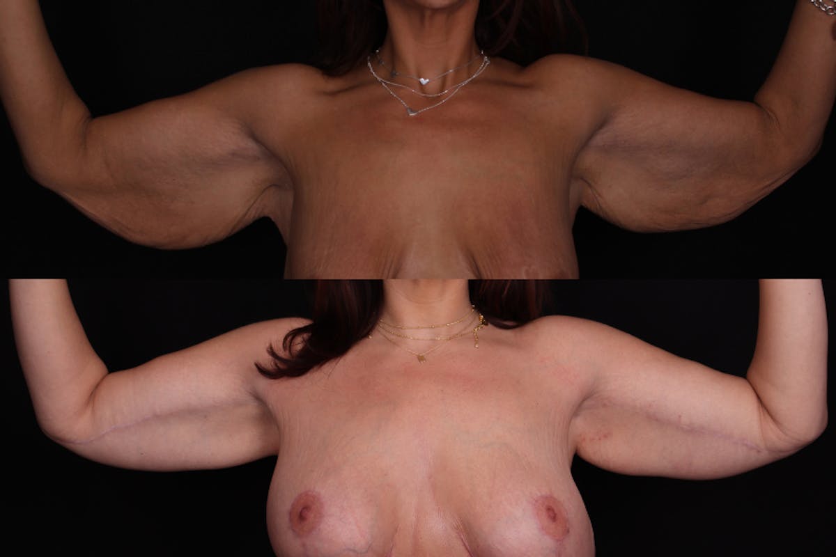 Arm Lift Before & After Gallery - Patient 371253 - Image 1