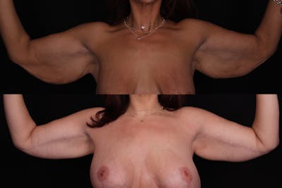 Arm Lift Before & After Gallery - Patient 371253 - Image 1