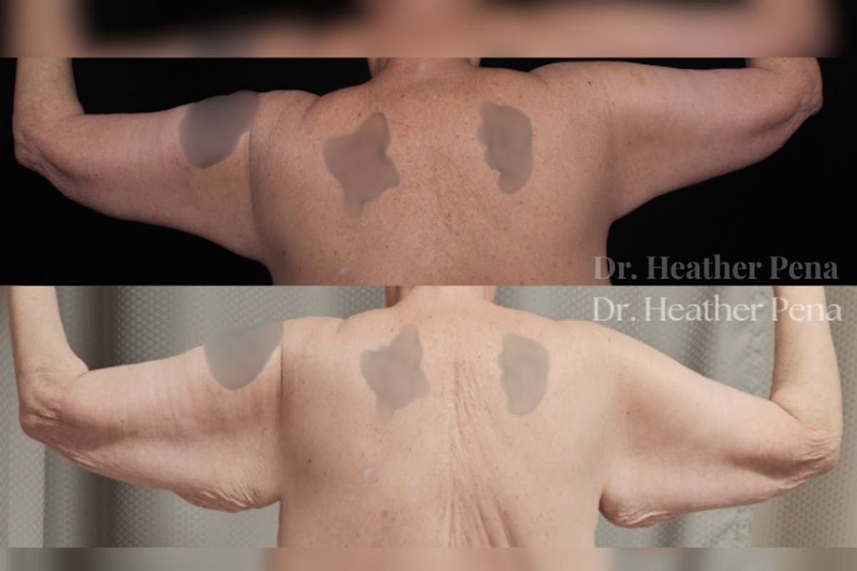 Arm Lift Before & After Gallery - Patient 536574 - Image 2