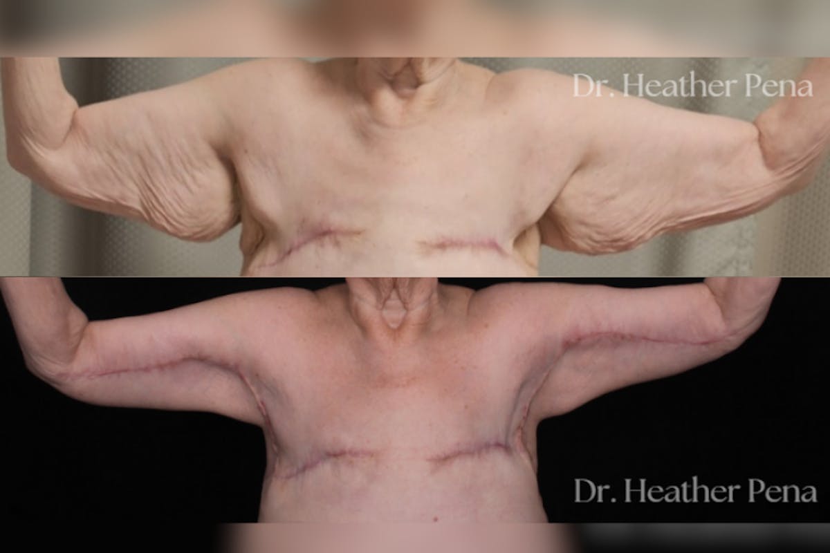 Arm Lift Before & After Gallery - Patient 536574 - Image 1