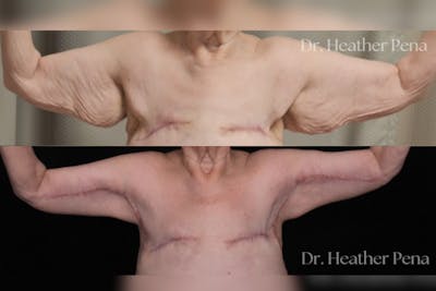 Arm Lift Before & After Gallery - Patient 536574 - Image 1