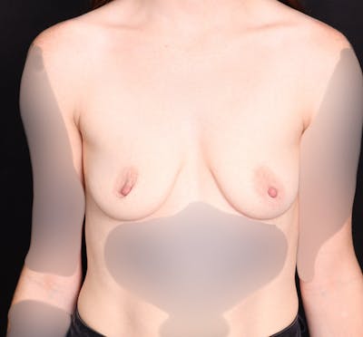Breast Augmentation Before & After Gallery - Patient 310378 - Image 1