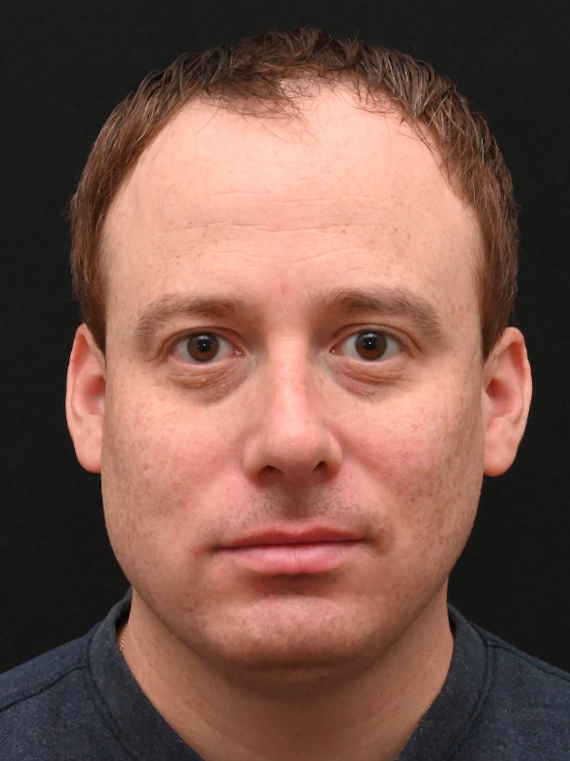 Rhinoplasty Before & After Gallery - Patient 404349 - Image 8