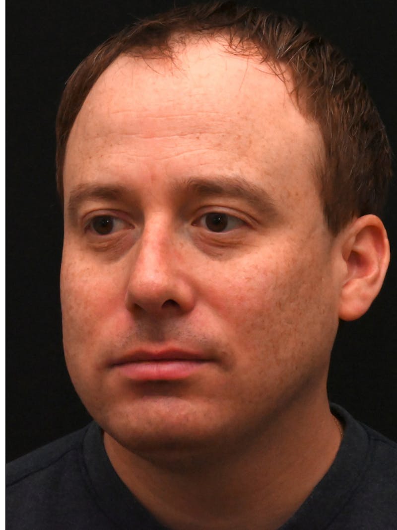 Rhinoplasty Before & After Gallery - Patient 404349 - Image 6