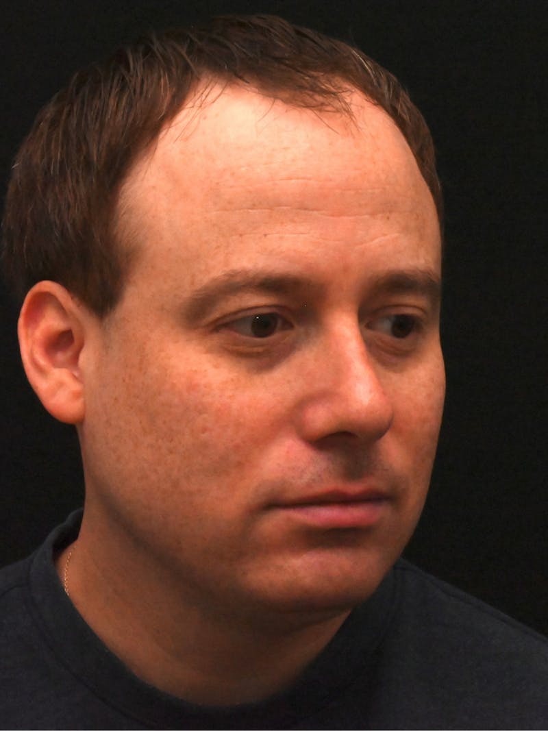 Rhinoplasty Before & After Gallery - Patient 404349 - Image 4