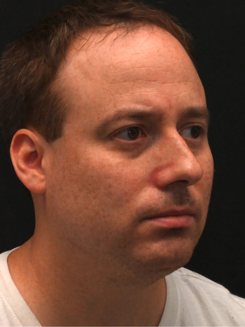 Rhinoplasty Before & After Gallery - Patient 404349 - Image 3