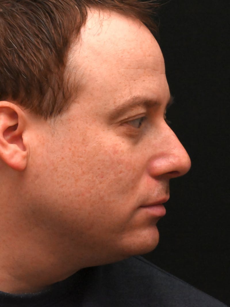 Rhinoplasty Before & After Gallery - Patient 404349 - Image 2