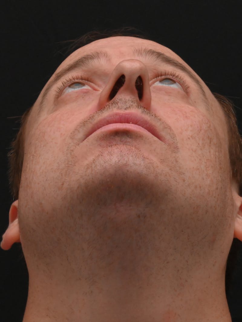 Rhinoplasty Before & After Gallery - Patient 404349 - Image 9