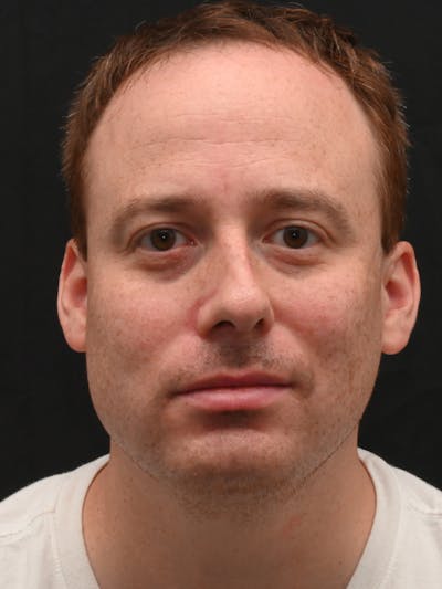 Rhinoplasty Before & After Gallery - Patient 404349 - Image 1