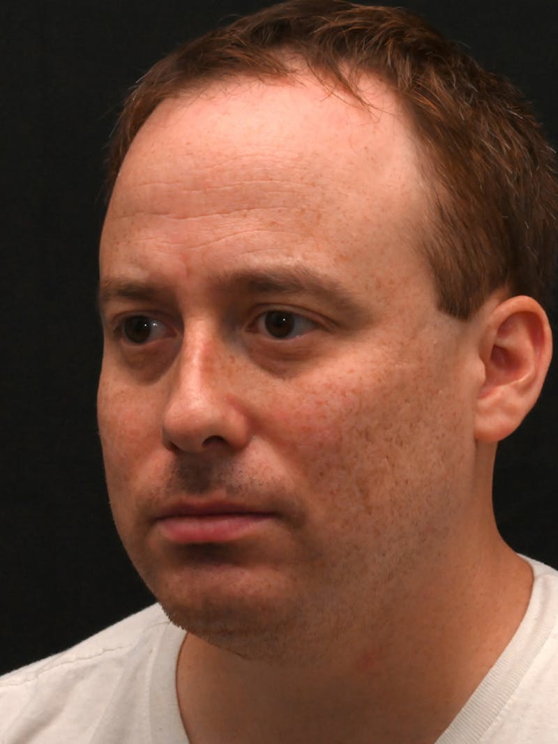 Rhinoplasty Before & After Gallery - Patient 404349 - Image 5