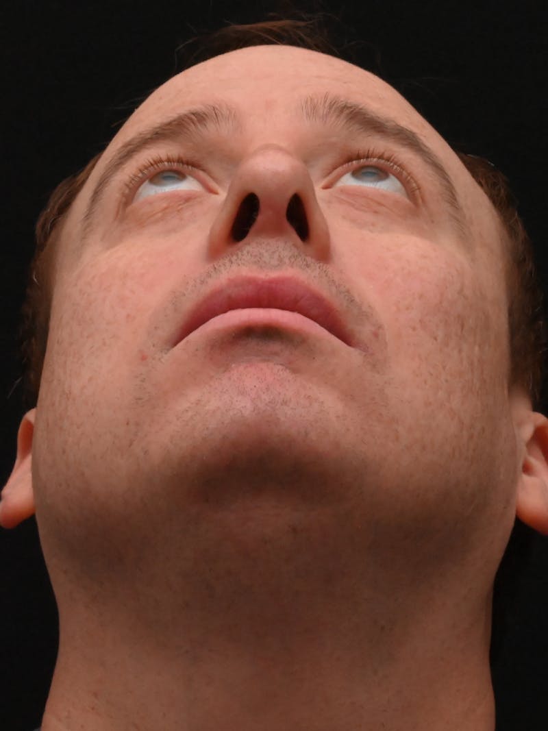 Rhinoplasty Before & After Gallery - Patient 404349 - Image 10