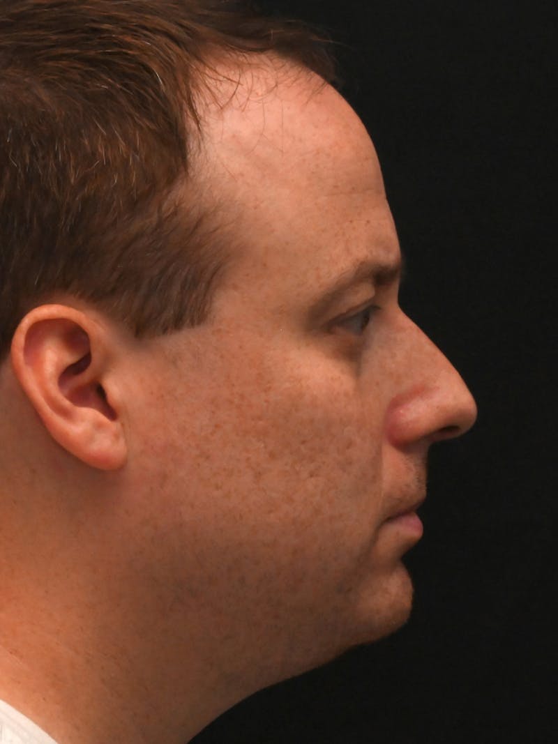 Rhinoplasty Before & After Gallery - Patient 404349 - Image 1