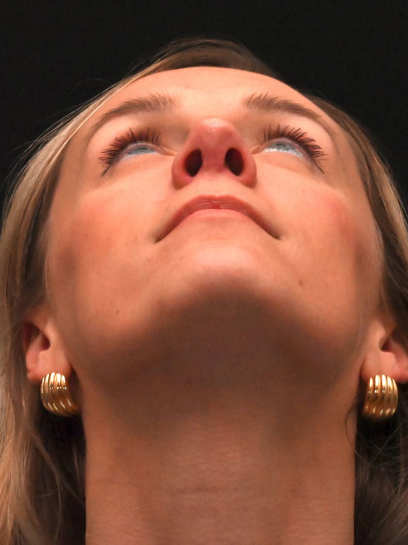 Revision Rhinoplasty Before & After Gallery - Patient 559631 - Image 12