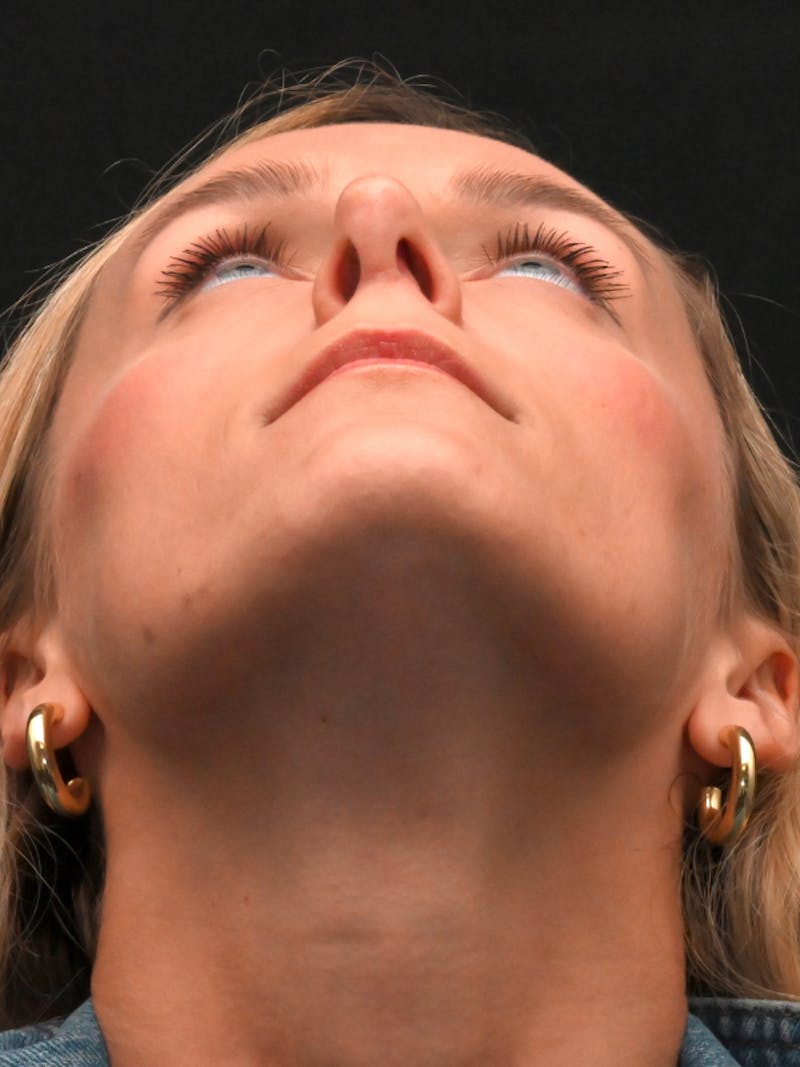 Revision Rhinoplasty Before & After Gallery - Patient 559631 - Image 11