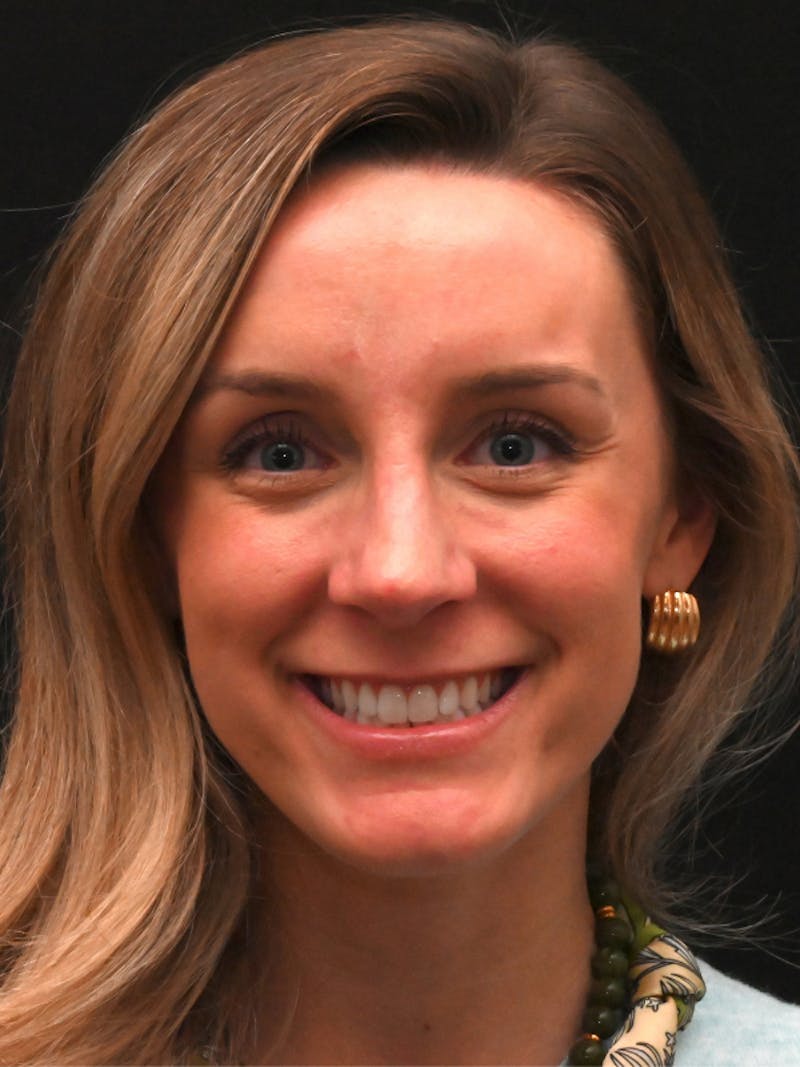 Revision Rhinoplasty Before & After Gallery - Patient 559631 - Image 6