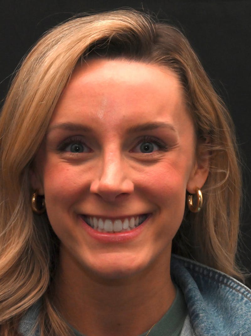 Revision Rhinoplasty Before & After Gallery - Patient 559631 - Image 5