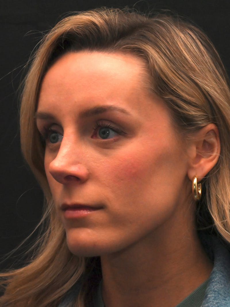 Revision Rhinoplasty Before & After Gallery - Patient 559631 - Image 7