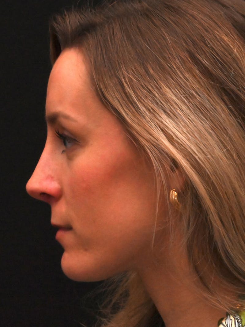 Revision Rhinoplasty Before & After Gallery - Patient 559631 - Image 10