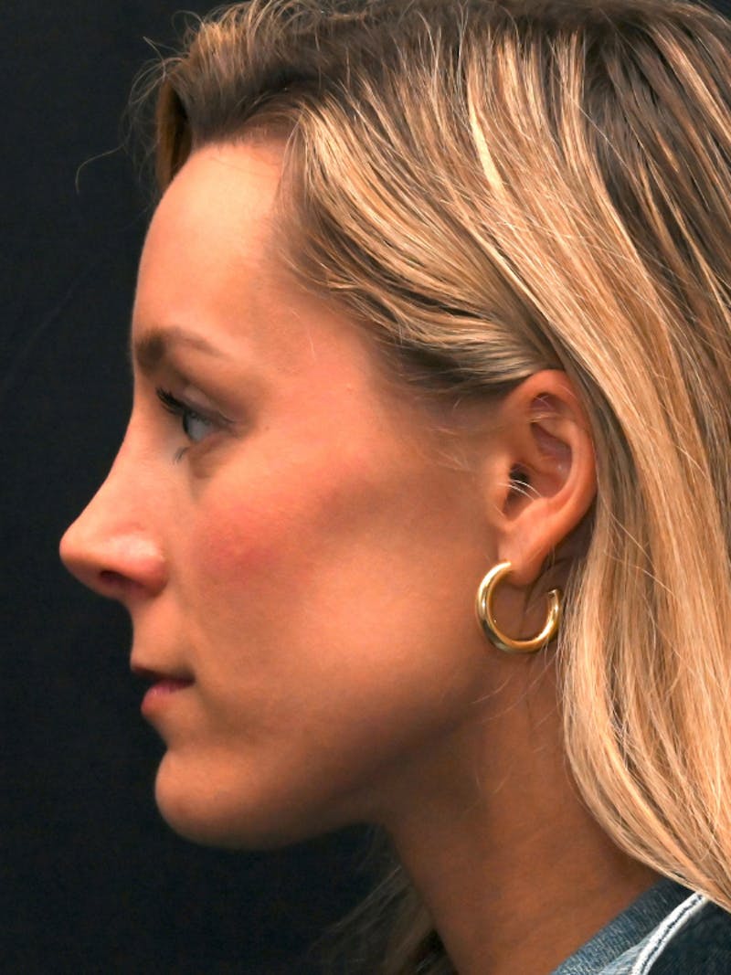 Revision Rhinoplasty Before & After Gallery - Patient 559631 - Image 9