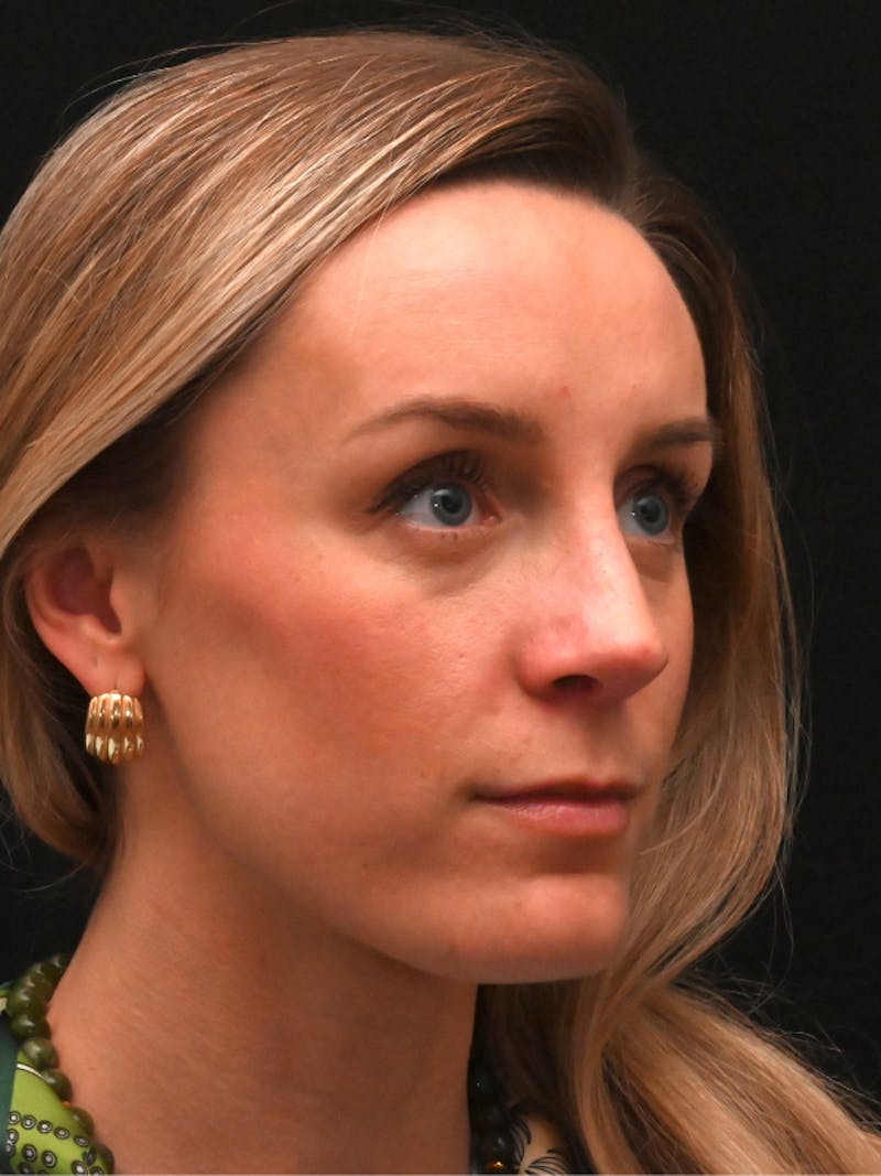 Revision Rhinoplasty Before & After Gallery - Patient 559631 - Image 4