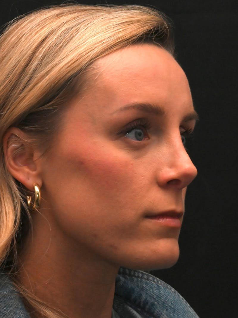 Revision Rhinoplasty Before & After Gallery - Patient 559631 - Image 3