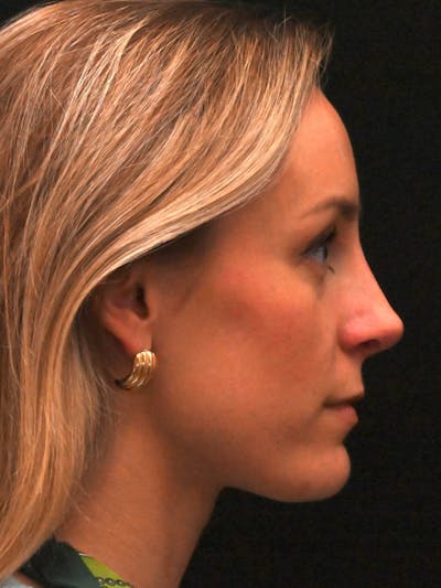 Revision Rhinoplasty Before & After Gallery - Patient 559631 - Image 2