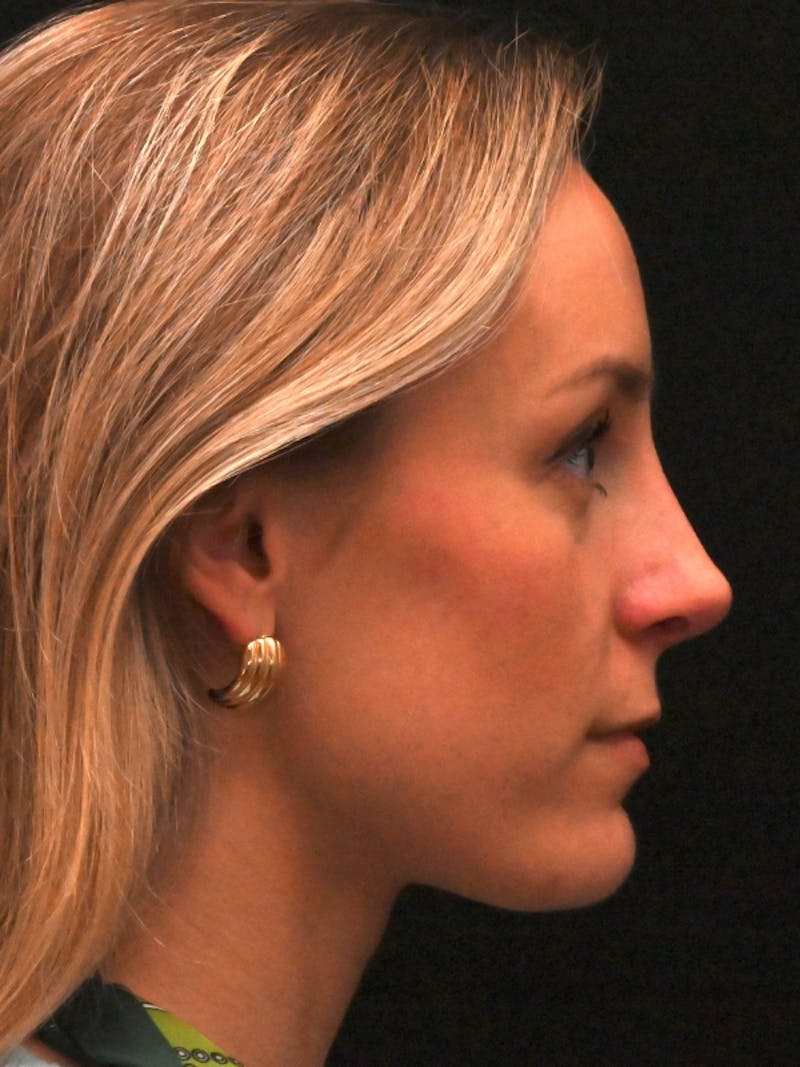 Revision Rhinoplasty Before & After Gallery - Patient 559631 - Image 2