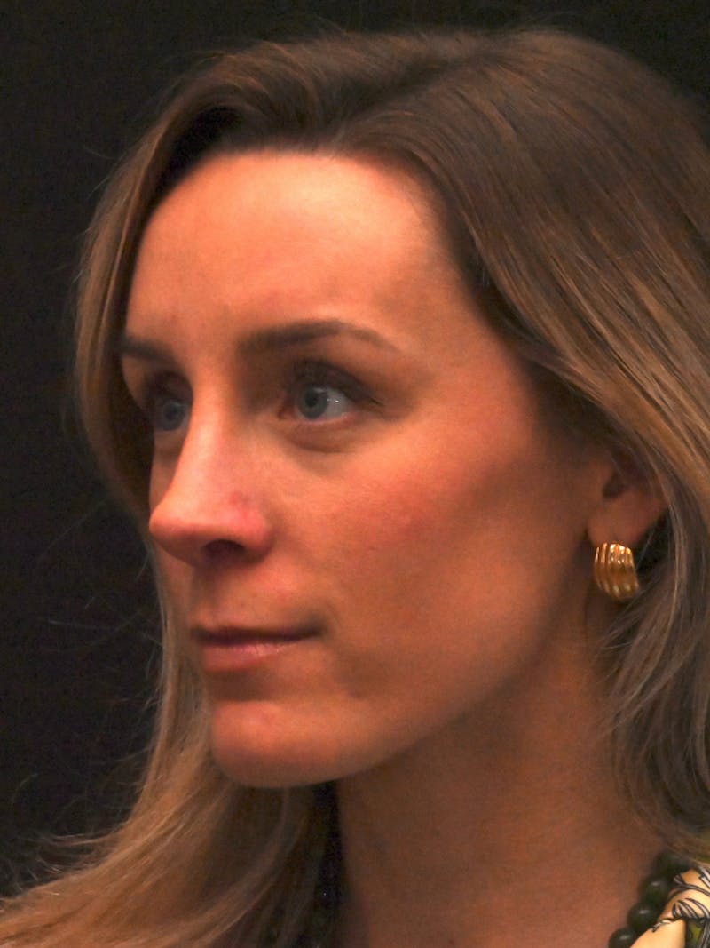 Revision Rhinoplasty Before & After Gallery - Patient 559631 - Image 8