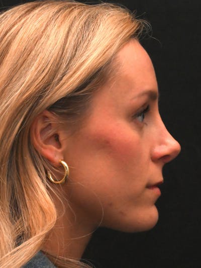 Revision Rhinoplasty Before & After Gallery - Patient 559631 - Image 1