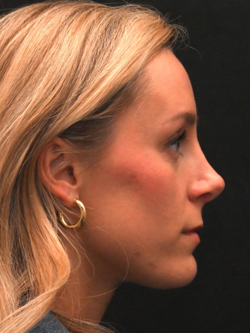 Revision Rhinoplasty Before & After Gallery - Patient 559631 - Image 1