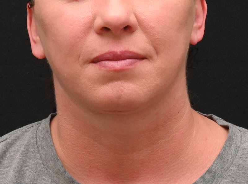 Deep Plane Facelift & Neck Lift Before & After Gallery - Patient 278512 - Image 6